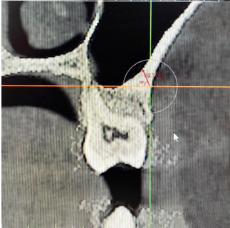 IZC bone thickness measured at 70° insertion angulation