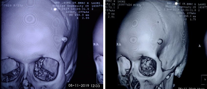 CT Head showing tumor characteristics