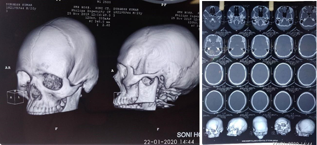 Showing radiological features of Fibrous dysplasia