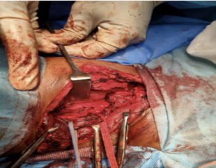 Thrombosed IJV visualized-ends secured by umbilical tape and feeding tube, carotid artery showing presence of clot, thyroid lobe retracted by langenbacks retractor.