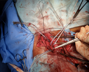 Post op carotid arteryrepair.Both ends of carotid artery secured with feeding tubes and repair done by 4-0 prolene.