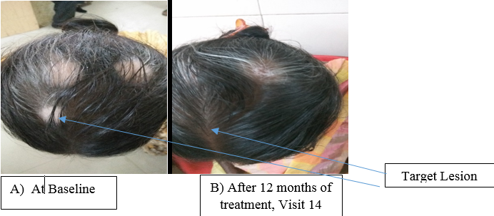 Grade 6 response following application of combination of bFGFrP 0.1% solution and Tacrolimus ointment.