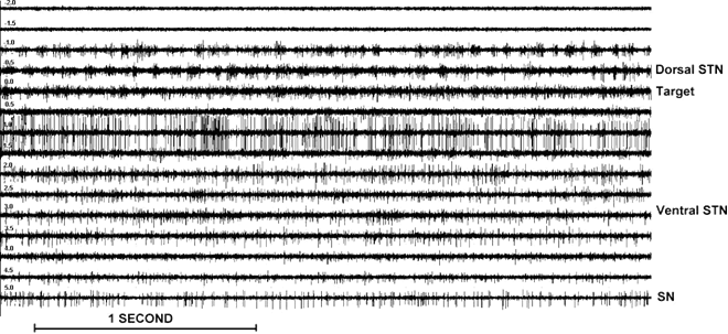 Sub thalamic neural movement and behavioral-activity for differentintensities:−2 and +5m m). Observe the minus readings relate to locational-points over the aimed region of STN. Insignificant s t n region−1 and 0m m) is distinctly established through the upsurge and inside and afterwards related-noise` as well as an abrupt rise within the rate-of-discharge (emitting)characterized by rhythmic bursts of activity in this case from 15 to 25 Hz. Deeper layers of the STN (+1.5 to 3.5 mm) show a more irregular high-frequency discharge pattern. SN activity (+5 mm) consists of a low-frequency tonic discharge.