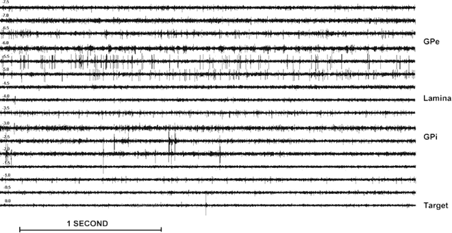 Single/multi-unit activity of global pallidus nucleus intensity`s(−7.5mm and to the 0mille meters).