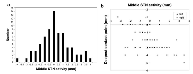 A: The frequency allocation of sub thalamic nucleus center of microrecordinng activity and behavior through in regard to magnetic resonance based objective image of s-nuclei B: `Scatter-plot` of connection among sub thalamic nucleus centre of micro recording-activity(parallel) as well as the last and final-end intensity of the earnest contacting-site (perpendicular) in regard to magnetic resonance based imaging objective o the sub thalamic nucleus aimed/target. The nucleus data of right brain as well as left-brain sub thalamic nucleus neurons were pooled.30, 31