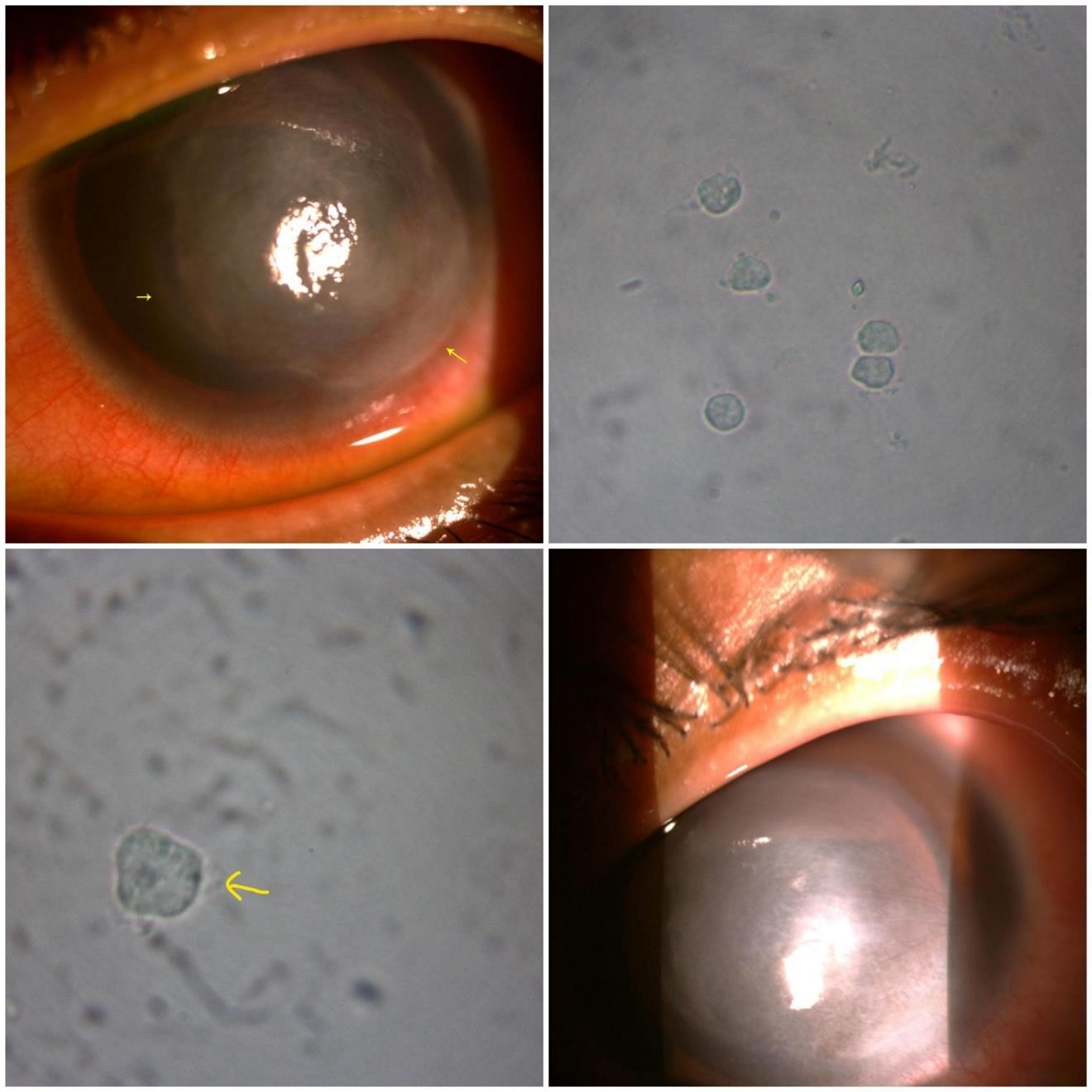 Case 1: Reader’s view; upper left. Healing Acanthamoeba ulcer: epithelial ulcer infero- temporally (big arrow), part of ring infiltrate still discernable (small arrow). upper right. Trophozoites of acanthamoeba under microscope (40 x 10) in direct wet mount showing irregular out line with finger like pseudopodia and prominent nucleus in each cell. (lower left) One trophozoite of acanthamoeba focused under high power magnification showing prominent nucleus and pseudopodia. (lower right) Healed acanthamoeba ulcer