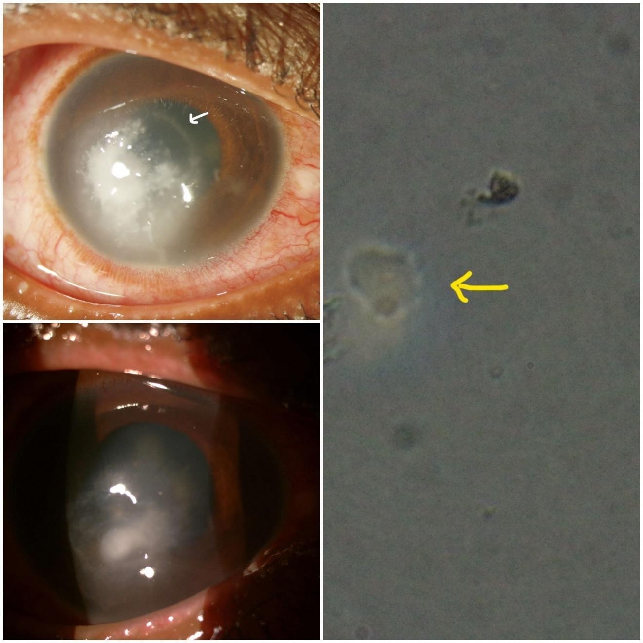 Case 2: (Reader’s view): upper left. epithelial ulcer and incomplete ring infiltrate (arrow). right. Acanthamoeba trophozoite in direct wet mount, horny surface with prominent nucleus. lower left. healed ulcer