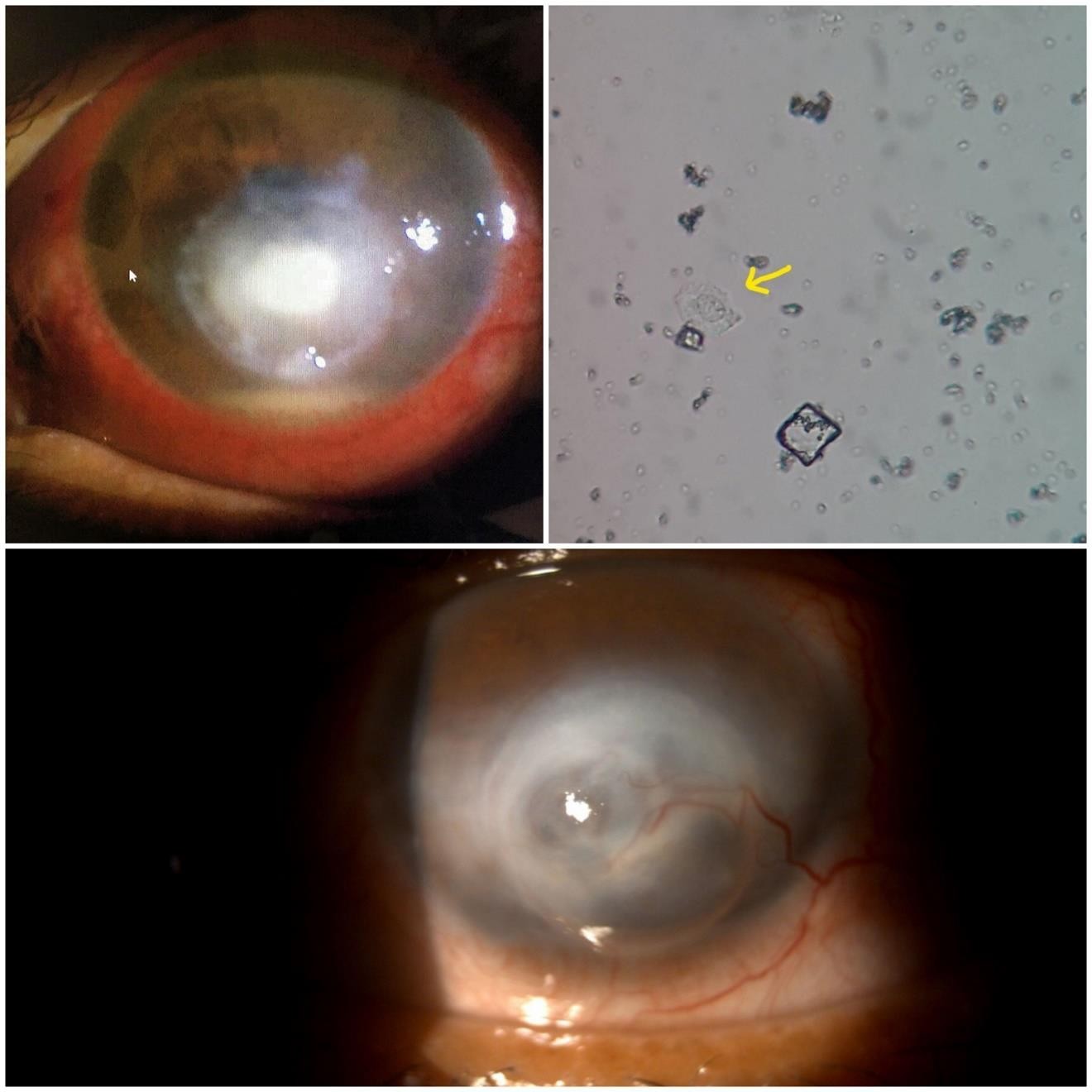 Case 3: (Reader’s view): upper left: round stromal infiltrate located slightly off-centre towards inferior quadrant with surrounding complete stromal ring infiltrate. upper right. trophozoite of Acanthamoeba, horny surface with prominent nucleus and pseudopodia. lower. Healed Ulcer. Fibrosis and thinning of cornea is seen