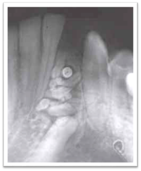 Compound odontoma