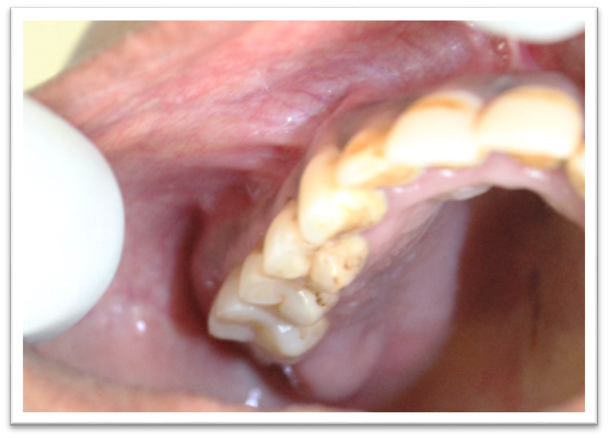 Intraoral clinical picture showing labial and buccal mucosae and buccal expansion irt 17