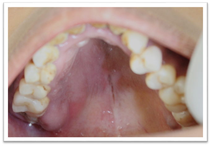 Intraoral clinical picture showing swelling involving the palate on right side