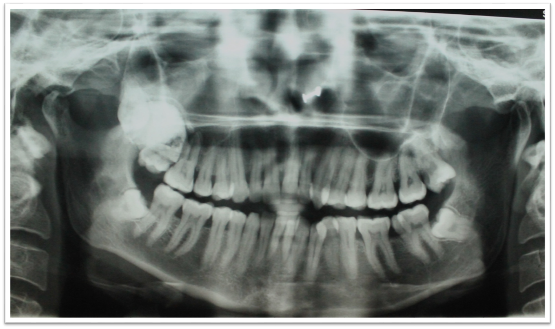 Panoramic radiograph