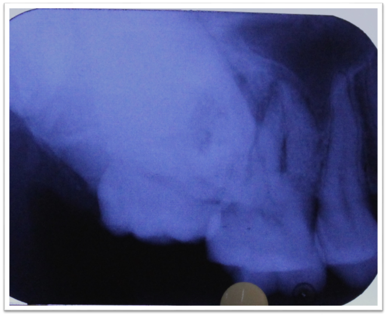 Periapical radiograph wrt 17,18 region