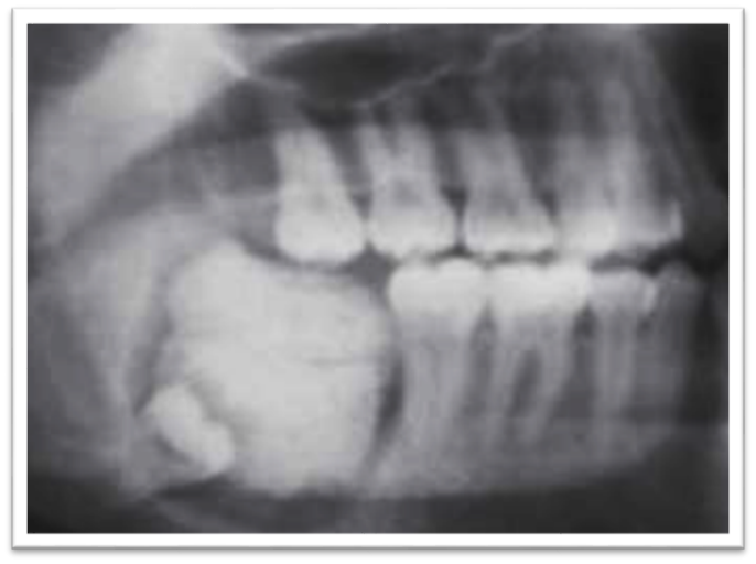 Complex odontoma in fourth quadrant