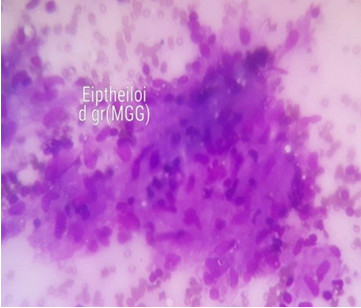 Photomicrograph showingepithelioid cell granuloma (Giemsa 40X)
