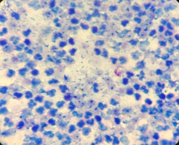 Photomicrographs showing AFB positive (ZN Stain 100 X)