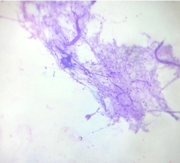 Photomicrograph showing sheets of mature adipocytes in lipoma (Pap 40X)