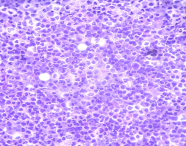 Photomicrographs showing polymorphs and cell debris in the necrotic background.(Pap stain 40X)