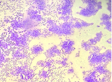 photomicrographs showing malignant ductal epithelial cells in clusters. (Pap 10X)