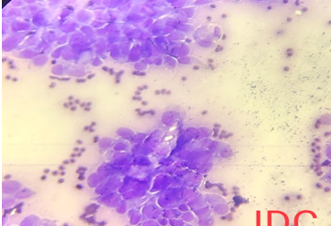 Photomicrographs showing malignant ductal epithelial cells in clusters. The cells are having moderate amount of cytoplasm, irregular nuclear margins, coarse clumped chromatin and occasional nucleoli. (MGG 40 X right)