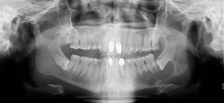 Showed a well-defiedunilocular radiolucency with respected to horizontal impacted left mandibular third molar and perforation of lingual cortical plate.