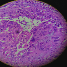 Histopathology picture revealed high mitotic activity with patchy areas of stromaldesmoplastic reaction and dense infiltrates of lymphocytes, plasma cells and neutrophils
