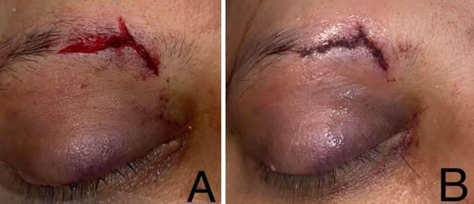 A: Eyelid edema, ecchymosis, and brow laceration due to a dumbbell injury in the gym; B: Repaired laceration.