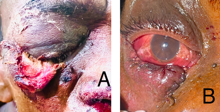 A: Eye lid laceration due to bull horn injury; B: Repaired laceration