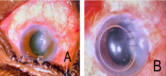 A: Corneal tear with Iris incarceration following blunt trauma, B: Repaired corneal tear