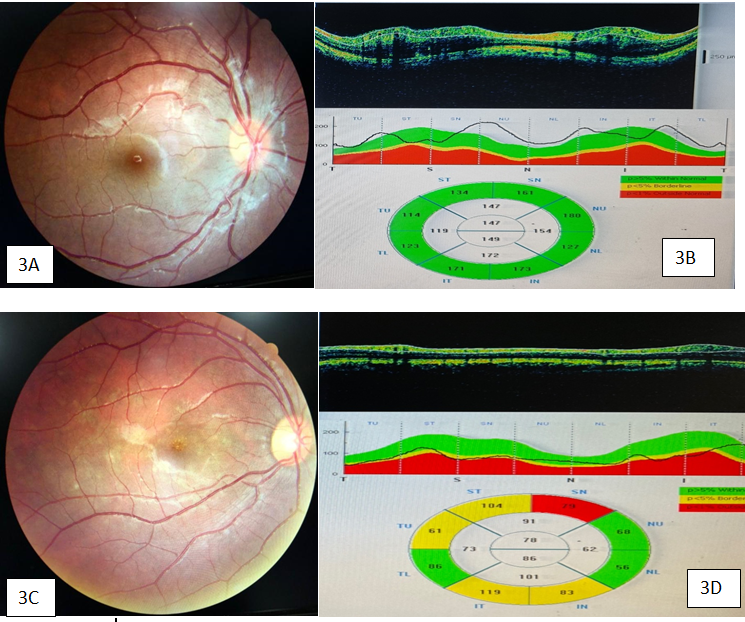 A): R/E fundus photo showing hyperemic disc;  B): OCT RNFL showing increased RNFL thickness in superior and nasal quadrant; C): R/E fundus photo showing temporal disc pallor; D): OCT RNFL showing borderline RNFL thickness in temporal half