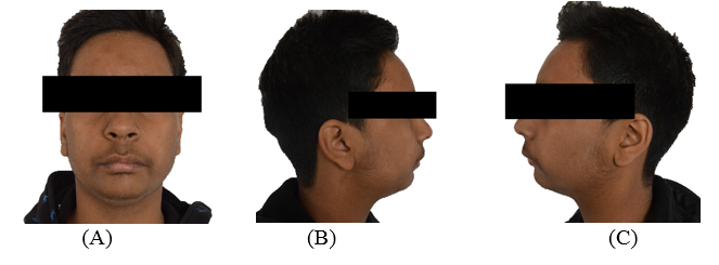 Extraoral pre-treatment photographs.