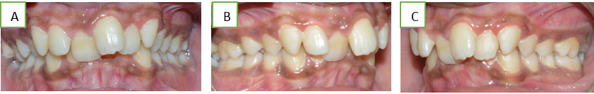 Intraoral pre-treatment photographs.