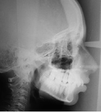 Pre-treatment lateral cephalogram.
