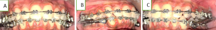 Mid treatment photographs.