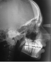Post-treatment lateral cephalogram.