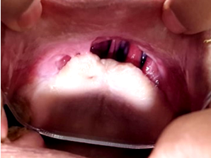 Pre-op intraoral view of patient before and after surgery