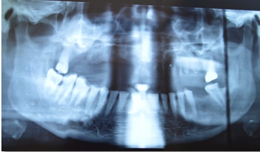 Pre-treatment OPG