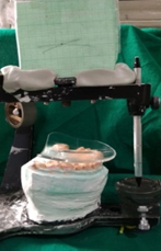 Correction of occlusal plane