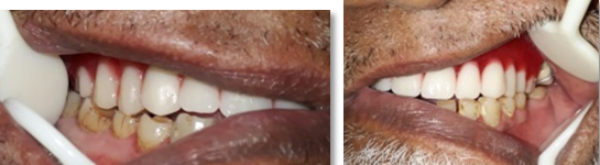 Intra-oral view during try-in