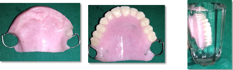 Final prosthesis with hollow bulb obturator