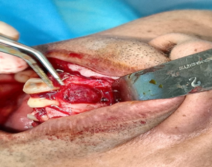 Mucoperiosteal flap elevated and the bony overlying the cyst