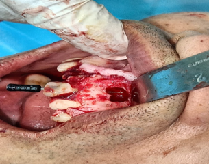Cyst was removed followed by RCT and apicectomy done.