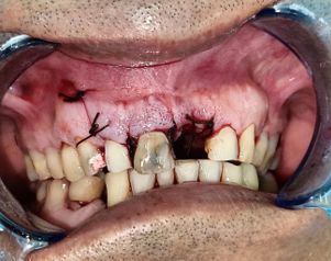 Flap closure was done by using a 3.0 silk suture.