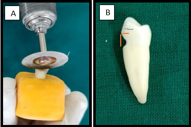 A,B: saucer shaped depression of 2.5 mm depth and 4 mm cervico occlusal legth prepared with bench grinder machine