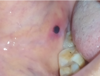 Intraoral lesion seen on buccal mucosa, Single, well defined