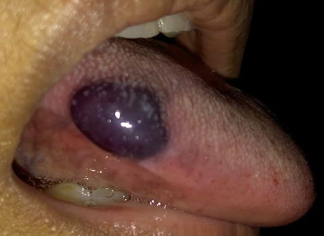 Single, well defined, nontender, bulla at lateral border of tongue