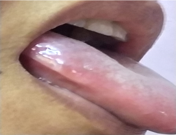 Lesionspontaneously ruptured and eventually healed