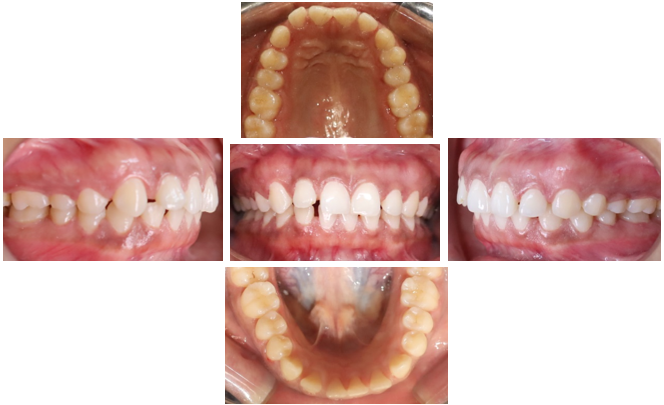 Pre-treatment intraoral photographs-when patient came for treatment of proclined teeth