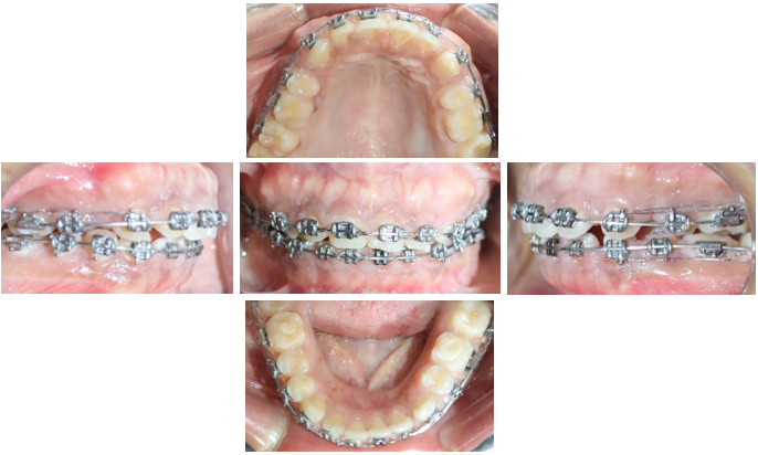 Individual canine retraction photographs