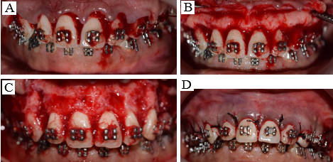 Surgical removal of ABE (A), (B) sulcular incision was made and a fullthickness mucoperiosteal flap was elevated (C) Osteoplasty procedure using carbide bur and generous irrigation removing the bony nodules (D) Sling sutures used to reposition the flap.